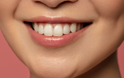 Faccette dentali estetiche: sorriso perfetto in poco tempo