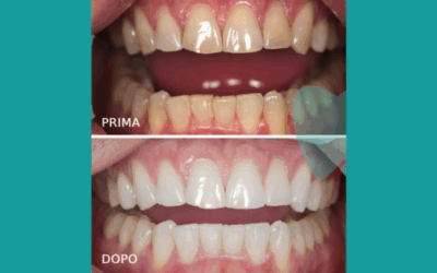 Sbiancamento dei denti: metodi, benefici e risultati duraturi