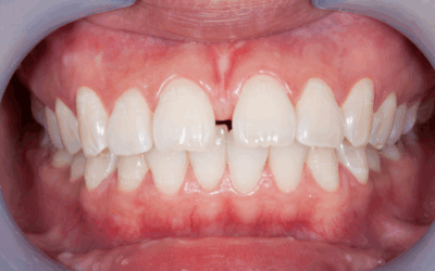 Diastema dentale: cos’è, cause e trattamenti disponibili alla Clinica Rocci