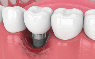 Perimplantite e impianti dentali: quando intervenire e perché