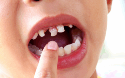 Trauma dentale nei bambini: cosa fare e quando andare dal dentista