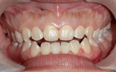 Hai il morso aperto? Scopri come intervenire e migliorare il sorriso