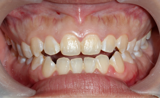 Hai il morso aperto? Scopri come intervenire e migliorare il sorriso