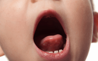 Frenulo linguale corto: conseguenze e trattamenti