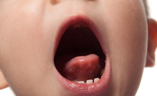 frenulo linguale corto