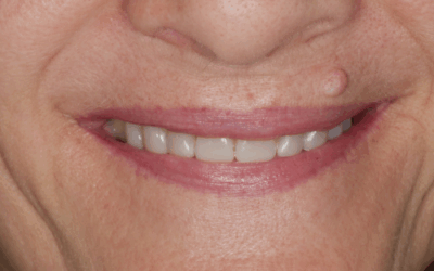 Injection Technique in odontoiatria estetica: quando sceglierla