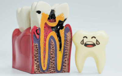 Prevenire la progressione della carie: cosa sapere e cosa fare subito