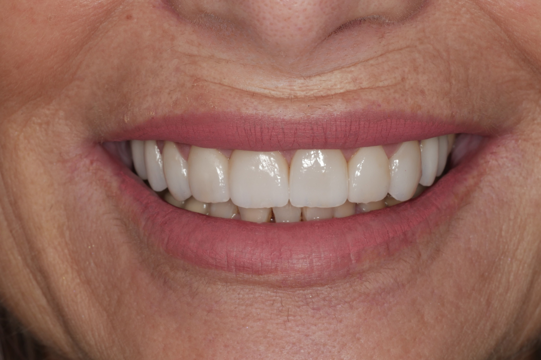 sorriso con faccette