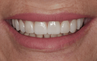 Faccette dentali: quanto durano davvero e come prolungarne la vita