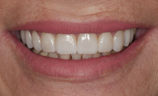 faccette dentali cover