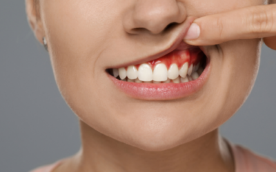 Ascesso gengivale: cause, sintomi e come intervenire tempestivamente