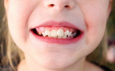 Come correggere l’affollamento dentale: dall’apparecchio fisso agli allineatori invisibili