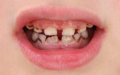 Denti macchiati nei bambini: perché succede?