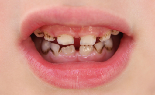 denti macchiati bambini