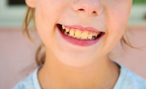 denti gialli bambini
