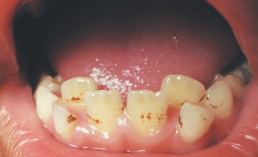 denti macchiati bimbi
