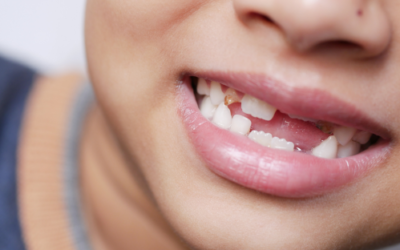 Agenesia dentale: cos’è e come ripristinare i denti mancanti
