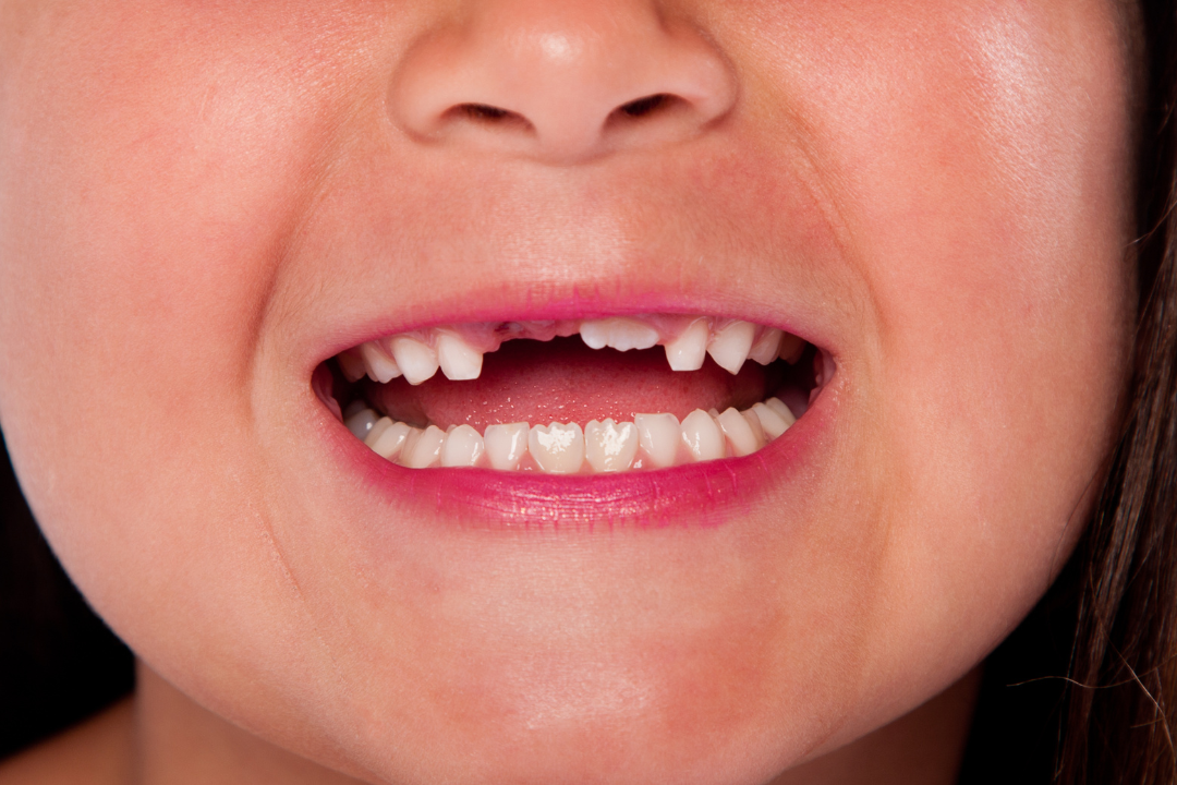 denti mancanti