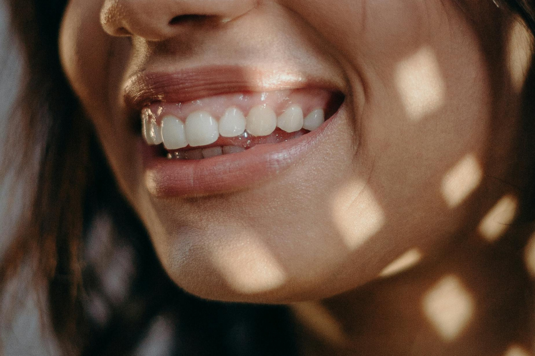 sorriso gengivale