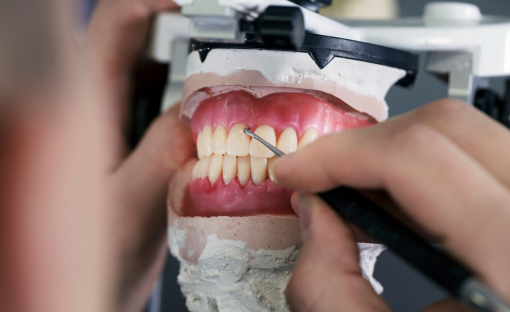 Apicectomia dentale: quando è necessaria, come si esegue e tempi di guarigione