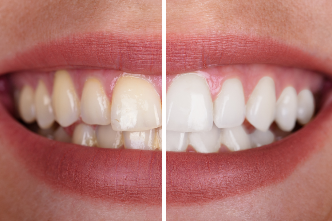 fumo denti