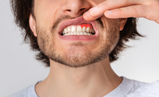 Iperplasia gengivale: dall’igiene orale alla chirurgia, ecco come ritrovare il tuo sorriso