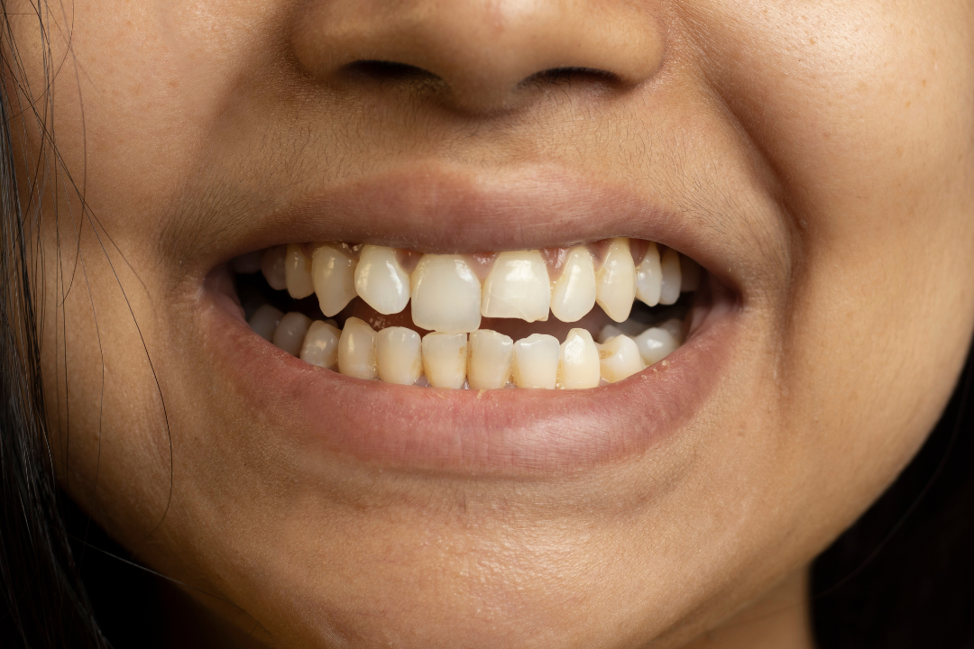 dente rotto