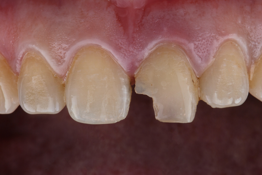 dente scheggiato