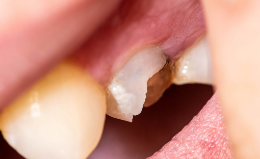 dente scheggiato cover
